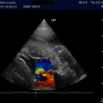 Herz-Ultraschall