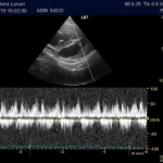 Herz-Ultraschall
